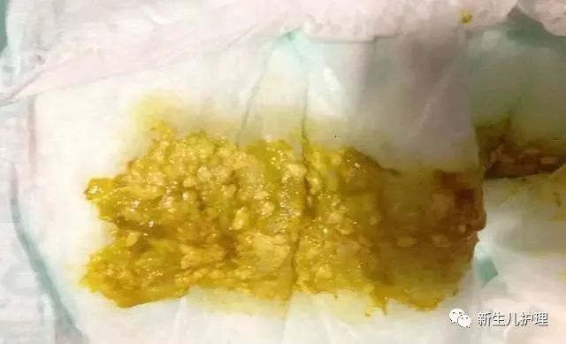 九个月大的宝宝拉稀屎是正常的吗？解读婴儿消化健康与异常情况